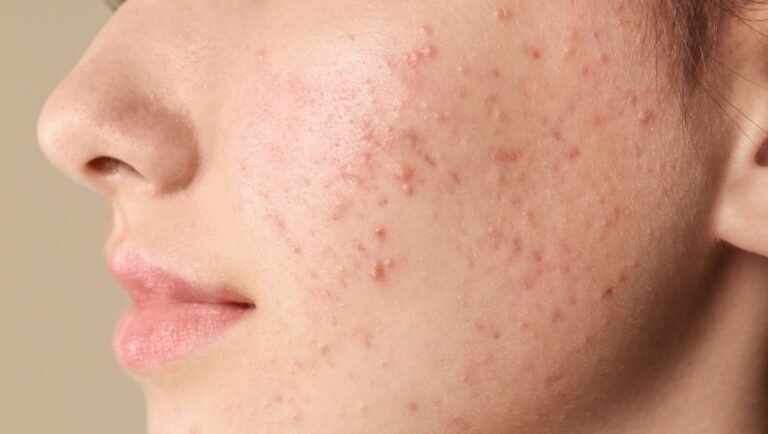 Denifanstat acne treatment results boost confidence
