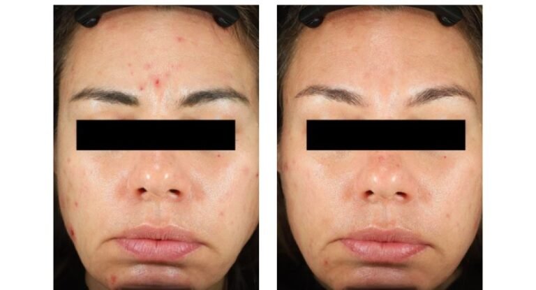 Nutrafol acne supplement efficacy proven in new trial