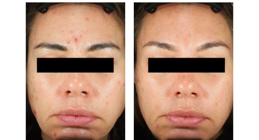 Nutrafol acne supplement efficacy proven in new trial
