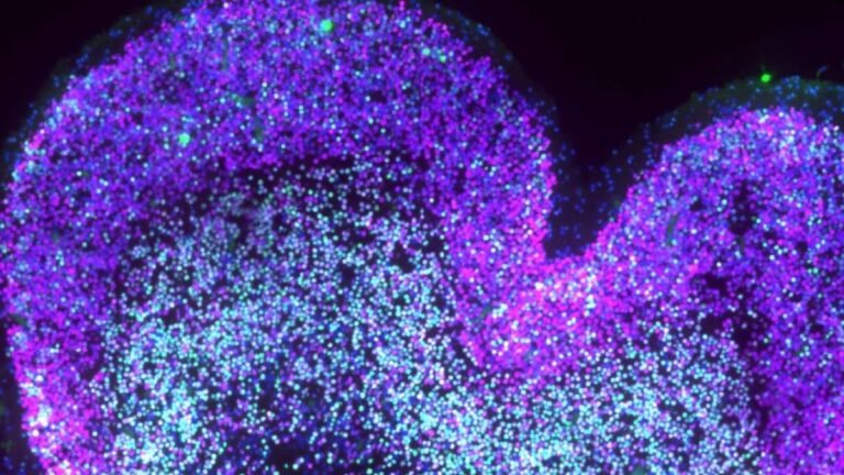 Prenatal neurogenesis down syndrome: a new brain map