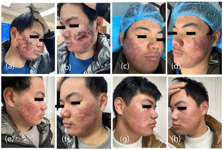 Revolutionizing acne care: 5-aminolaevulinic acid acne treatment