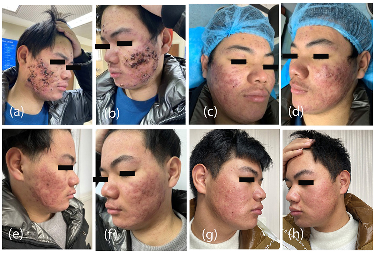Revolutionizing acne care: 5-aminolaevulinic acid acne treatment